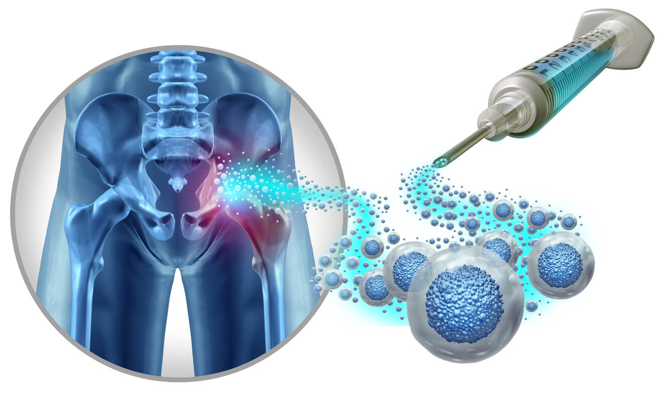 stem cell therapy in sarnia 